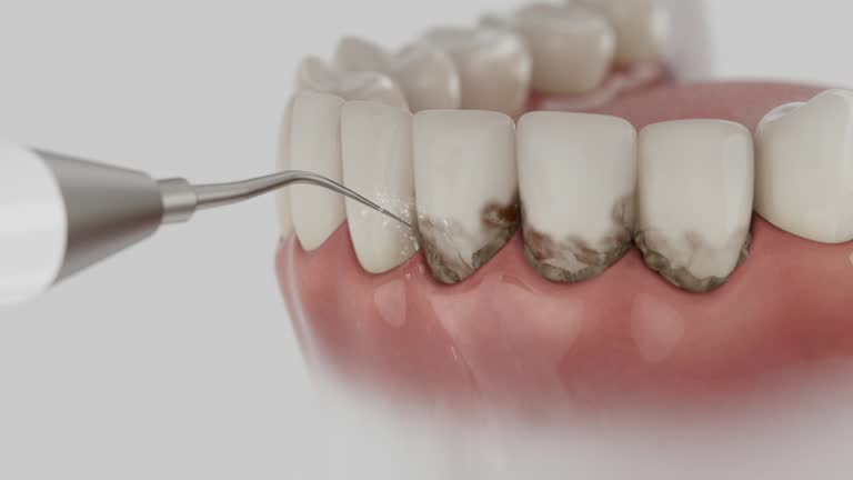 Trusted Wisdom Tooth Removal service in Snellville, GA - Dentist Open Now